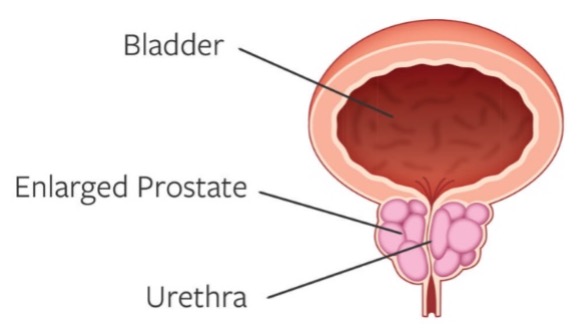 Enlarged prostate graphic